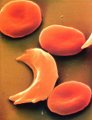 Sickle_Cell.jpg
